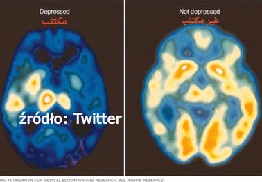 Tak wygląda mózg człowieka z depresją 