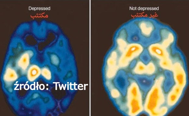 Tak wygląda mózg człowieka z depresją 