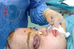 Tak wygląda pacjentka po przeszczepie twarzy [Uwaga, drastyczne zdjęcia!]