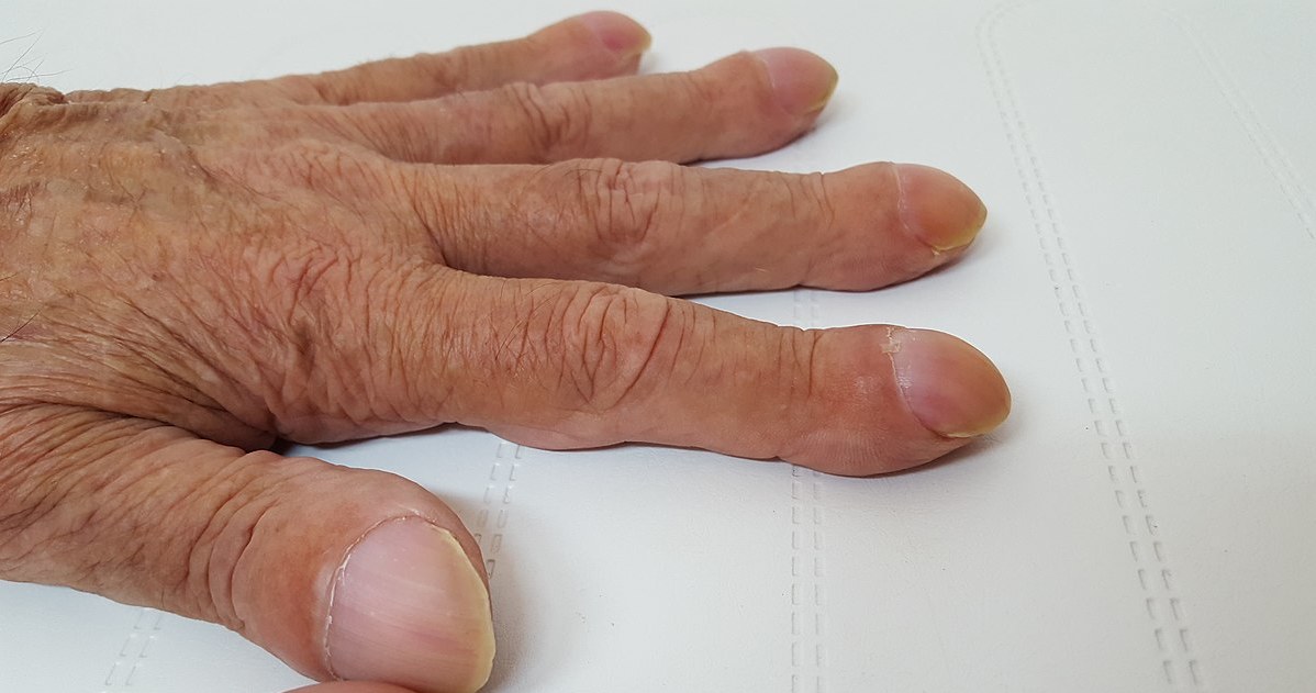 Tak wyglądają palce pałeczkowate. Objaw ten występuje w przebiegu wielu chorób /Wesalius/ Wikimedia Commons/  Creative Commons Attribution-Share Alike 4.0 International license /