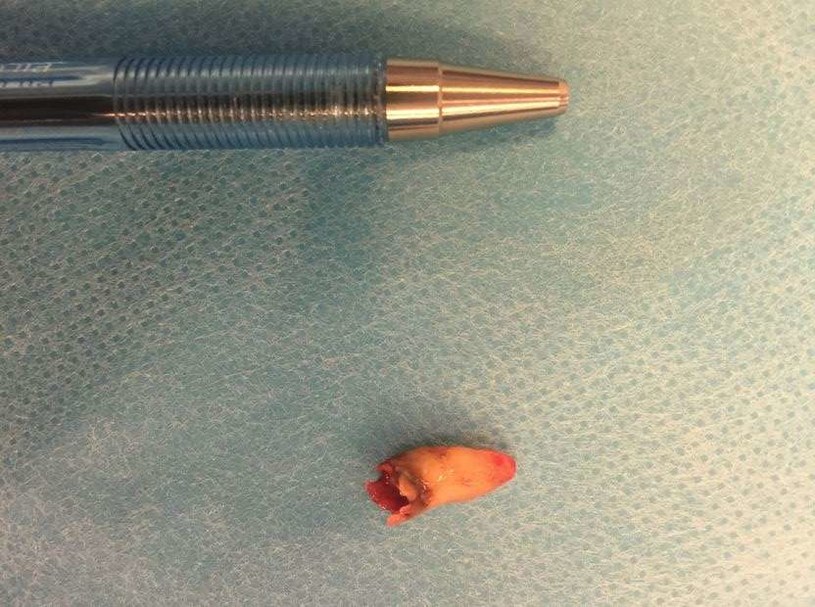 Taki ząb lekarze usunęli z nosa 59-letniego mężczyzny /Fot. BMJ Case Reports /materiały prasowe