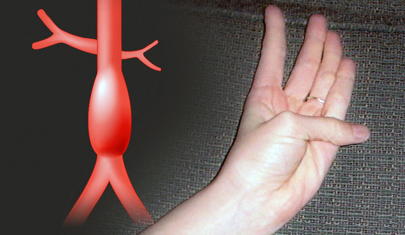 Takie ułożenie kciuka może wskazywać na ukrytego tętniaka aorty /Fot. Uniwersytet Yale /materiały prasowe