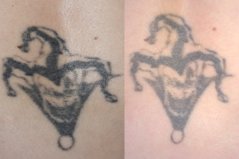 Tatuaż tydzień (po lewej) i dwa tygodnie po pierwszym zabiegu usuwania /Styl.pl