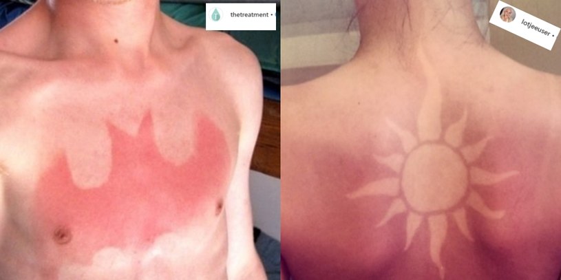 "Tatuaże" od poparzeń słonecznych to nowa niepokojąca moda /Instagram