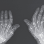 Teleskopowe palce - rzadkie schorzenie dotykające kości