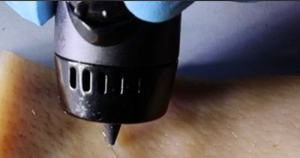 Ten długopis do drukowania 3D maluje żel, który może pomóc w szybkim i skutecznym gojeniu się ran o dowolnym kształcie /Na podstawie ACS Applied Materials & Interfaces, 2023, DOI: 10.1021/acsami.3c03630 /materiały prasowe