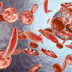 Terapia genowa sposobem na anemię sierpowatą