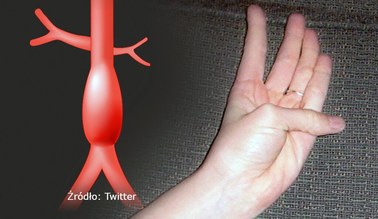  „Test kciuka” pomoże rozpoznać śmiertelną chorobę serca