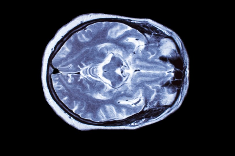 Tętniak mózgu może dotyczyć od 1-5 proc. populacji /123RF/PICSEL