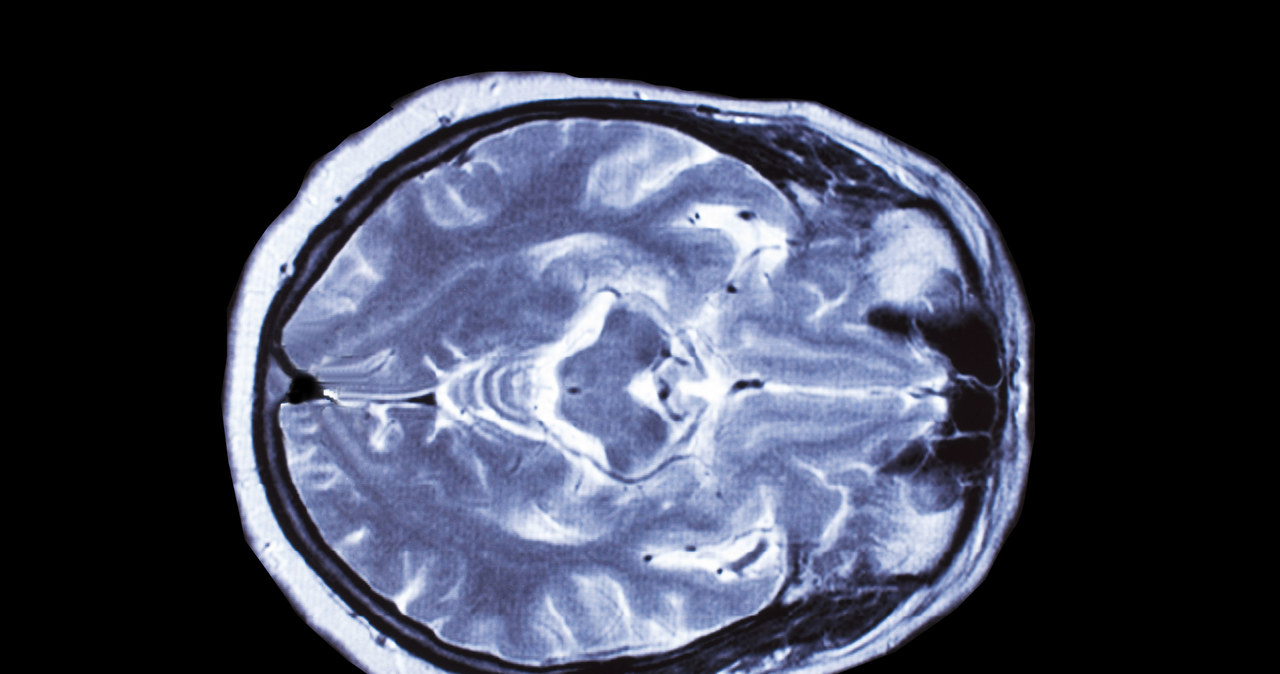 Tętniak mózgu może dotyczyć od 1-5 proc. populacji /123RF/PICSEL