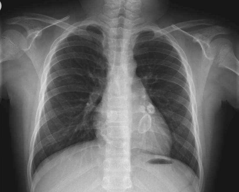 Tętniakowate zmiany i zwapnienia naczyń wieńcowych widoczne na przeglądowym radiogramie klatki piersiowej pacjenta z chorobą Kawasakiego /materiały prasowe