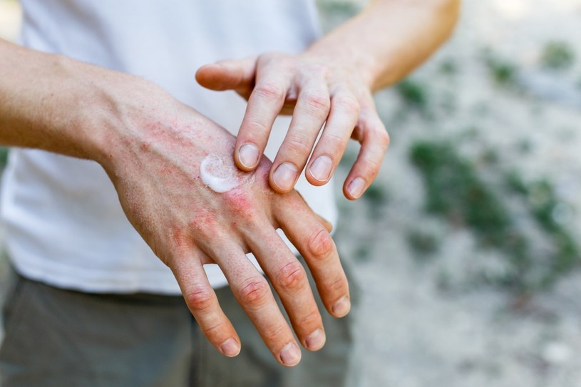 Też masz takie dłonie? Winne żele antybakteryjne, pierwsze chłody lub choroba /123RF/PICSEL