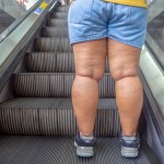 obrzęki nóg Tłuszczowy obrzęk zapalny nóg to lipedema. Pomogą ćwiczenia i odpowiednia dieta