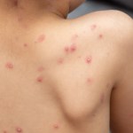 ospa prawdziwa To wina Brytyjczyków. Poznaliśmy przyczynę niszczycielskiej epidemii z 1789