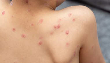 To wina Brytyjczyków. Poznaliśmy przyczynę niszczycielskiej epidemii z 1789