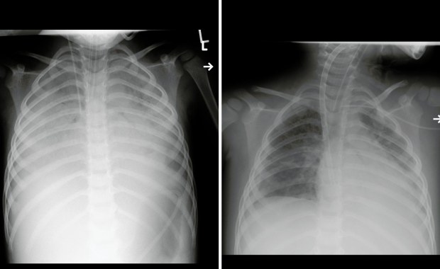 "To wręcz pożera płuca". Zdjęcia pacjentów po Covid-19 