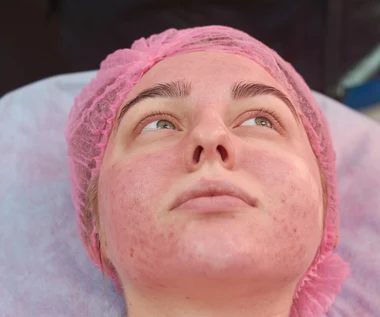 Toczeń rumieniowaty - groźniejszy, niż myślisz