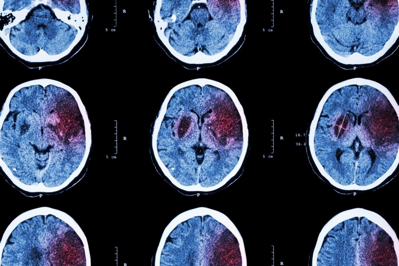 Tomografia komputerowa mózgu z widocznym zawałem niedokrwiennym /123RF/PICSEL