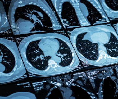 Tomografia płuc może uratować życie. Jakie choroby wykrywa i czy przysługuje na NFZ?