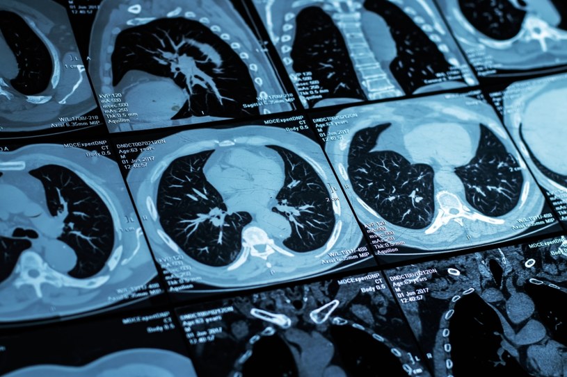 Tomografia płuc służy zarówno do wstępnej diagnostyki, jak i monitorowania przebiegu choroby /123RF/PICSEL