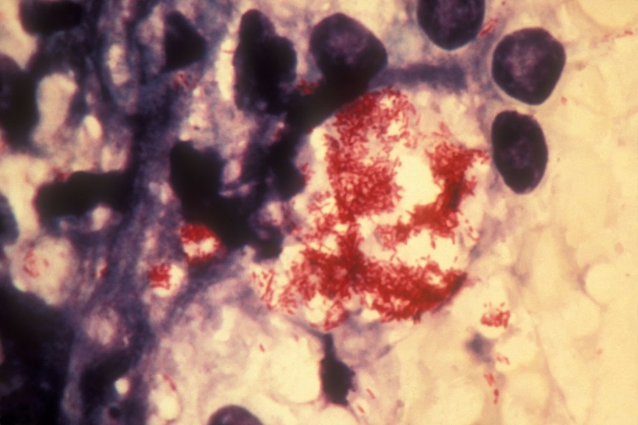 Trąd (lepra) to przewlekła choroba zakaźna wywoływana przez bakterię Mycobacterium leprae /SCIENCE PHOTO LIBRARY/Science Photo Library/East News /East News