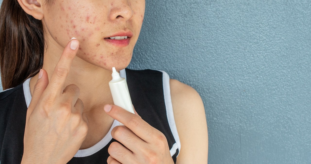 Trądzik różowaty – odkryj, co naprawdę wywołuje ten problem skórny /123RF/PICSEL