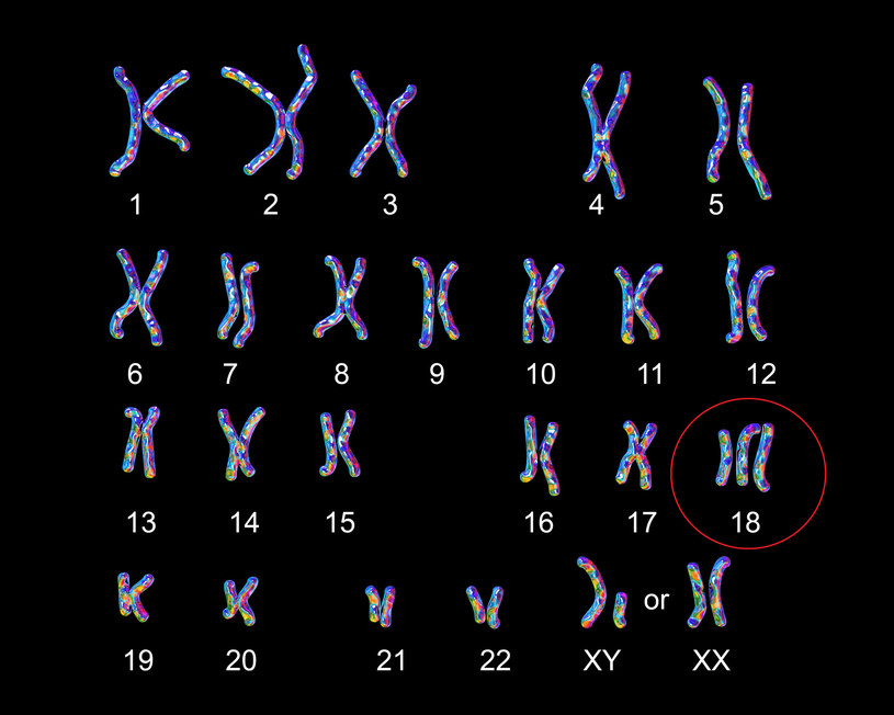 Trisomia 18 pary chromosomów wywołuje u płodu szereg wad letalnych
