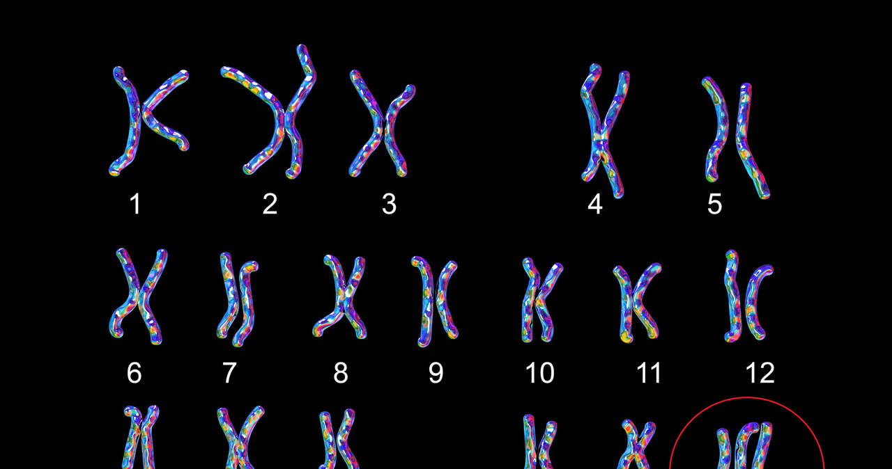 Trisomia 18 pary chromosomów wywołuje u płodu szereg wad letalnych /123RF/PICSEL