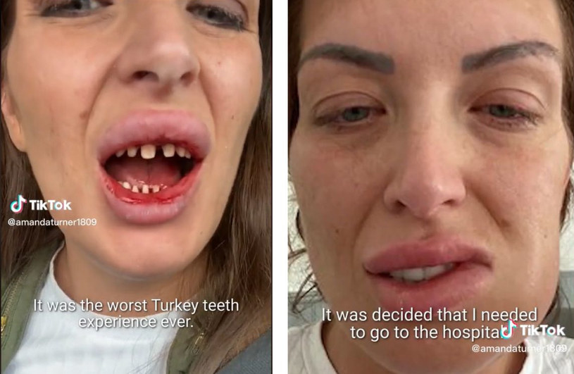 "Tureckie zęby" zamiast spełnieniem marzeń okazały się dla kobiety drogą przez mękę i cierpienie /TikTok