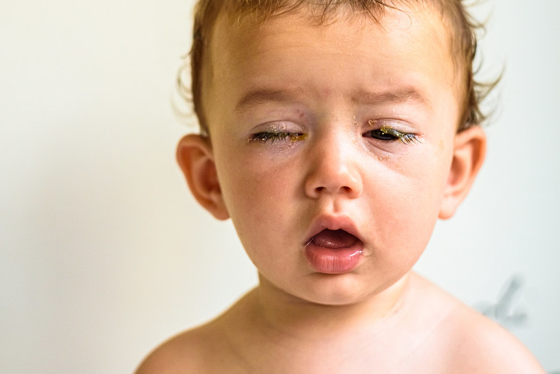 U dzieci najczęściej występuje bakteryjne zapalenie spojówek np. na skutek kontaktu z brudnymi przedmiotami /123RF/PICSEL