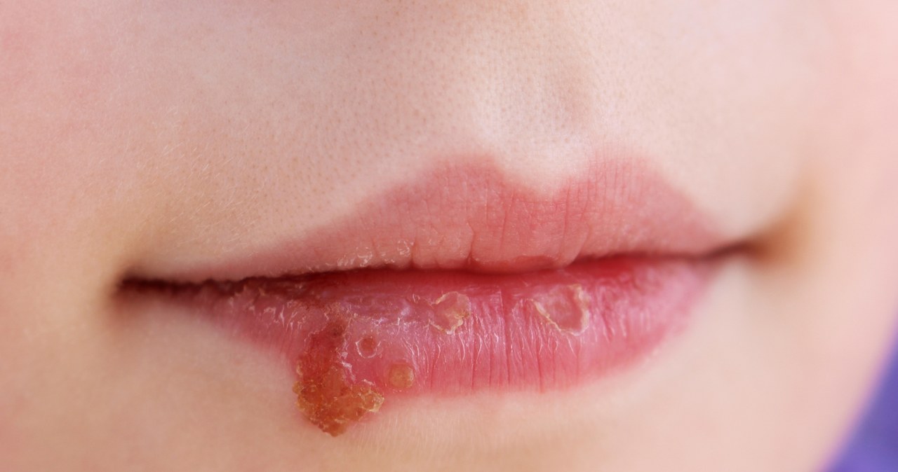 Kandydoza Jamy Ustnej Przyczyny Objawy Leczenie Zdrowie W Interiapl 1113