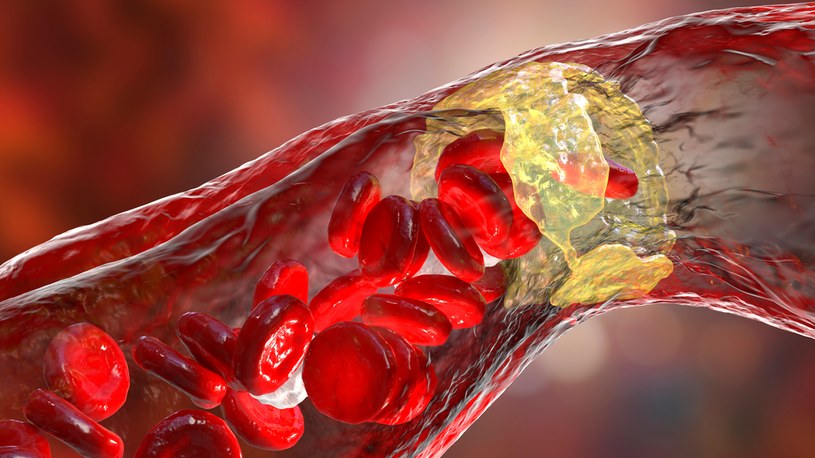 U osób z rodzinną hipercholesterolemią pierwsze blaszki miażdżycowe w obrębie tętnic można wykryć już w wieku 12 lat /123RF/PICSEL