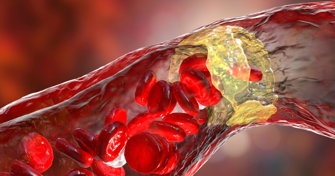 U osób z rodzinną hipercholesterolemią pierwsze blaszki miażdżycowe w obrębie tętnic można wykryć już w wieku 12 lat /123RF/PICSEL