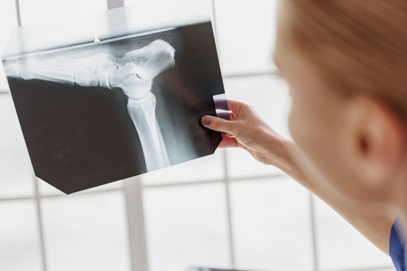 U pacjentów dotkniętych osteomalacją kości są zniekształcone i podatne na złamania /123RF/PICSEL