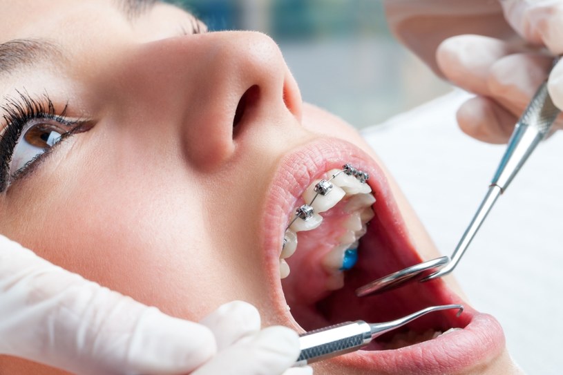 U stomatologa uczulać mogą materiały używane do wypełnień, a nawet lateksowe rękawiczki /123RF/PICSEL