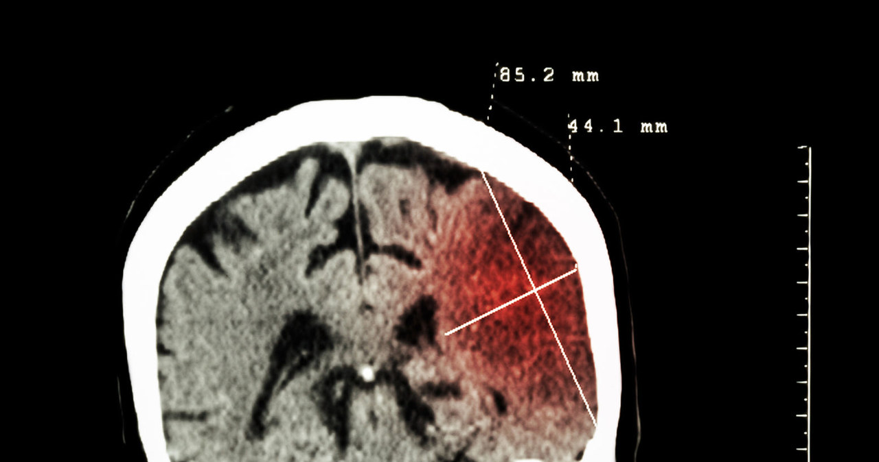Udar mózgu szczególnie niebezpieczny dla osób z COVID-19 /123RF/PICSEL