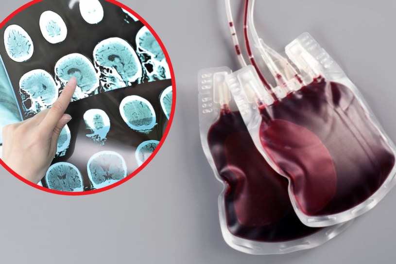 Udowodniono, że osoby z grupą krwi A częściej doznają udaru niedokrwiennego mózgu przed 60. rokiem życia /123RF/PICSEL