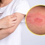 Ugryzienia i użądlenia owadów. Pająk, komar, mrówka czy pszczoła? Tak rozpoznasz, co cię ugryzło