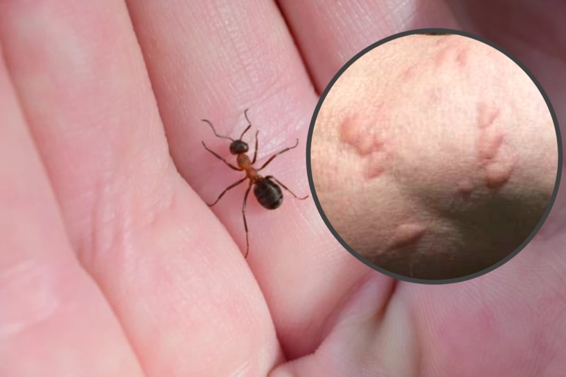 Ugryzienie przez mrówkę jest bolesne. Na skórze mogą pojawić się czerwone plamy lub bąble, które ustępują po krótkim czasie /Alfred Buschinger/Wikimedia /123RF/PICSEL