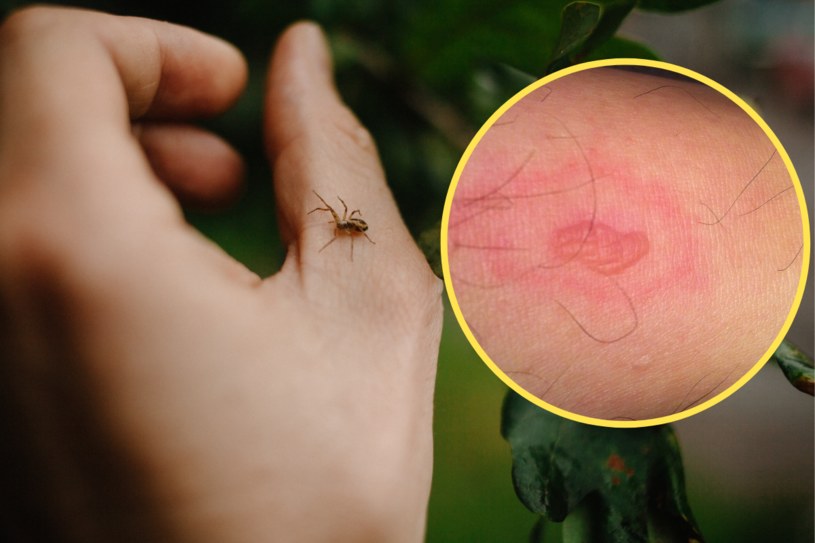 Ugryzienie przez pająka powinno być skonsultowane z lekarzem, bowiem może dojść do zakażenia skóry /Sebiwi/Wikimedia /123RF/PICSEL