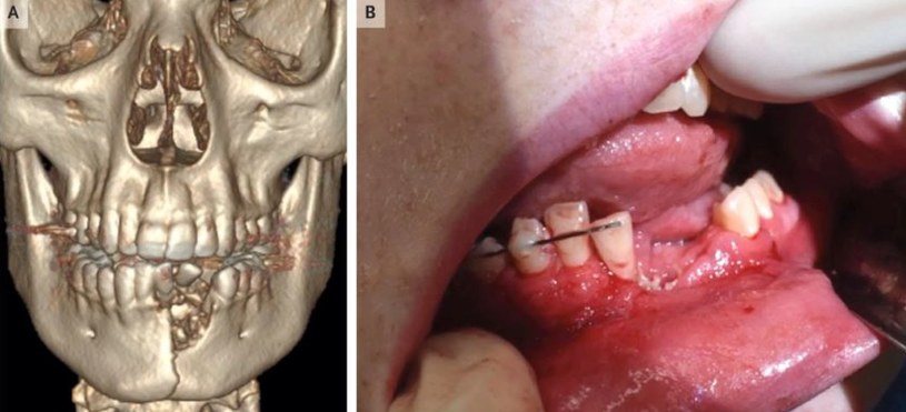 Uraz szczęki 17-latka był poważny /materiały prasowe