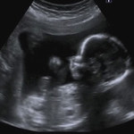 USG 3D podczas ciąży 