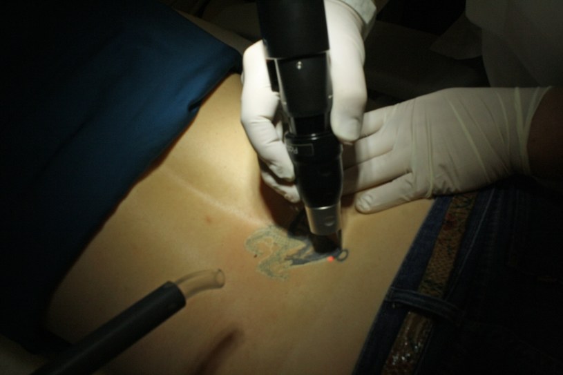 Usuwanie tatuażu za pomocą lasera PicoSure /Styl.pl