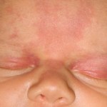 Uszczypnięcie bociana u noworodka. Skąd bierze się na ciele dziecka?