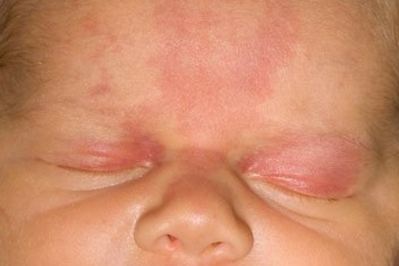 Uszczypnięciem bociana nazywane są naczyniaki płaskie, które występują u noworodków na czole, karku lub nad górną wargą /123RF/PICSEL