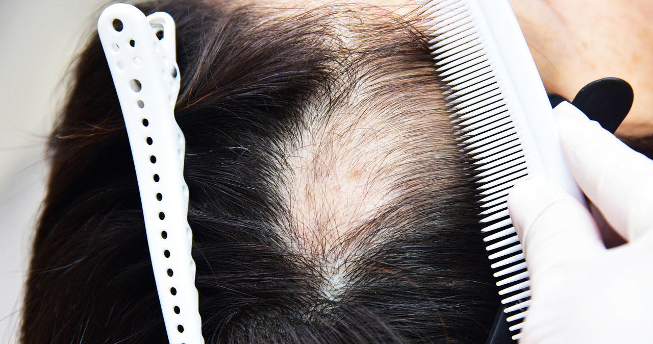 Utrata włosów może być konsekwencją po przebytym COVID-19 /123RF/PICSEL