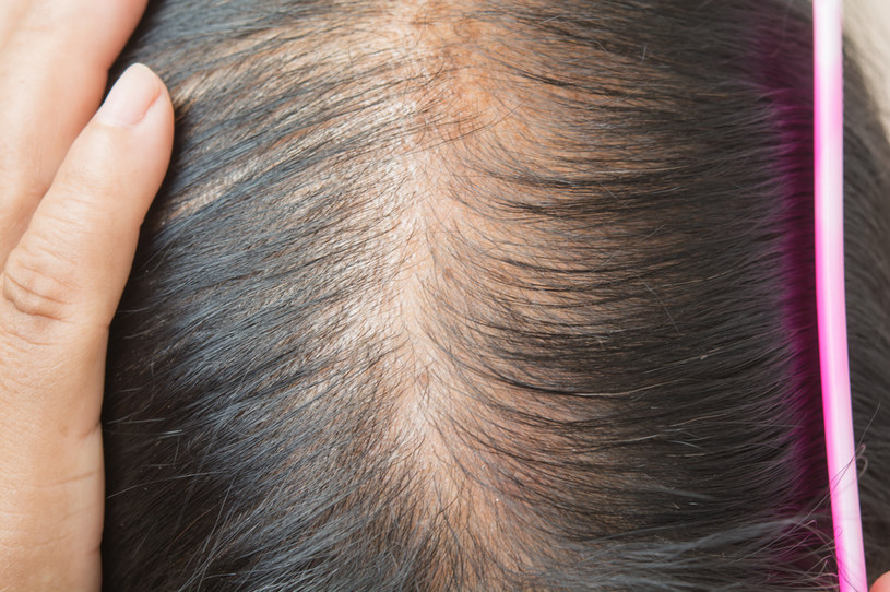 Utrata włosów może mieć tło nerwowe i być wynikiem stresu. Powodem może być niedobór białka /123RF/PICSEL