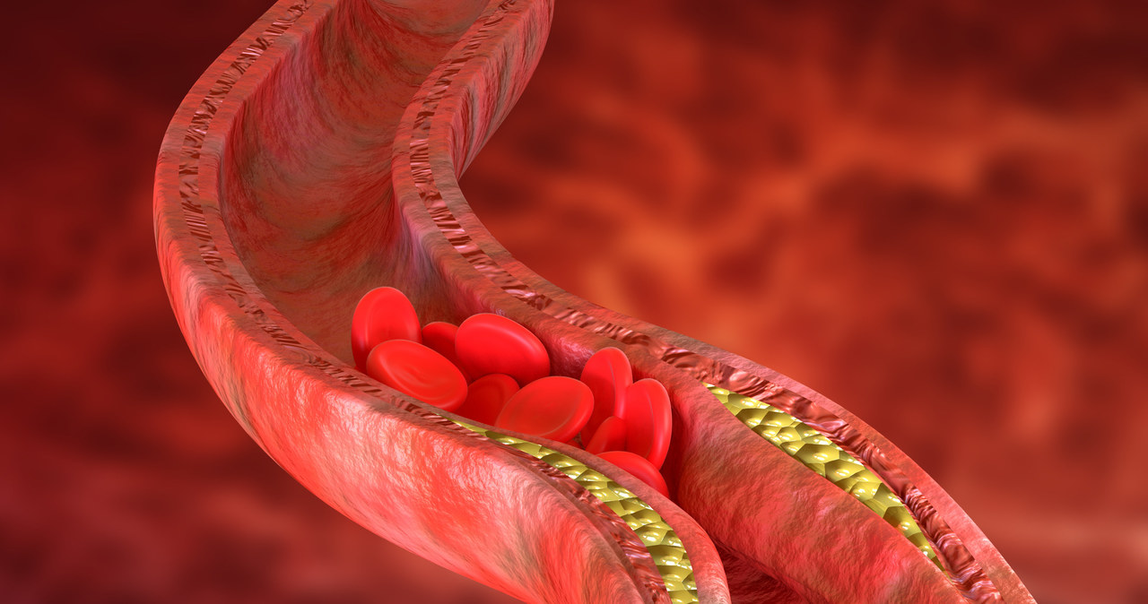 Utrzymywanie cholesterolu HDL na odpowiednio wysokim poziomie zmniejsza ryzyko rozwoju miażdżycy /123RF/PICSEL