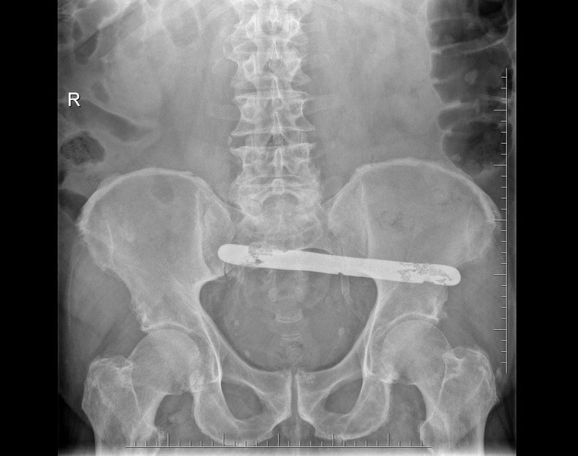 W brzuchu pana Janusza lekarze zostawili po operacji 17-centymetrowe metalowe narzędzie chirurgiczne /Archiwum Rzecznika Praw Pacjenta /materiał zewnętrzny
