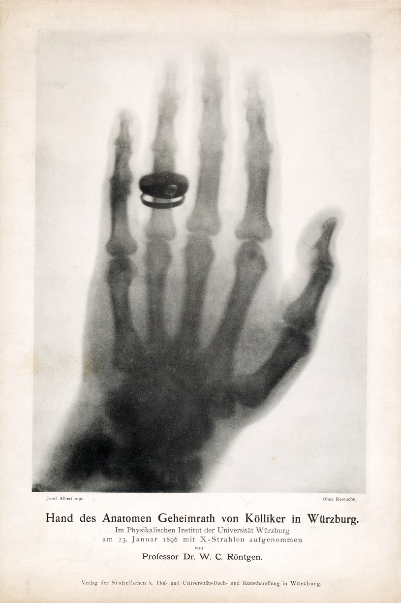 W.C. Röntgen, Obraz dłoni prof. A. Von Köllikera, 23 stycznia 1896 r. Dzięki uprzejmości Deutsches Rontgen-Museum, Remscheid /materiały prasowe